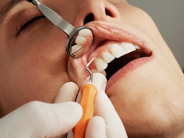 Caries dentaires décryptées: Prévention, soins et solutions pour un sourire radieux
